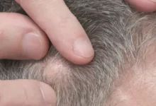 talgdrüsenkarzinom kopfhaut