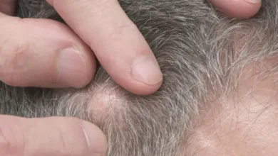 talgdrüsenkarzinom kopfhaut