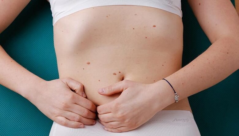 lymphödem bauch bilder